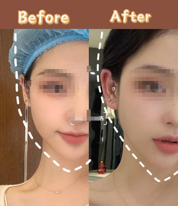 'Sốc': Cận cảnh quá trình phẫu thuật để đôi tai vểnh như tai yêu tinh của các cô gái trẻ - 2