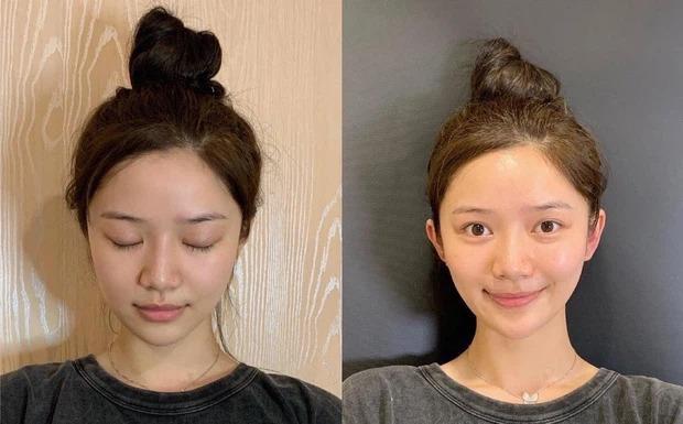 'Sốc': Cận cảnh quá trình phẫu thuật để đôi tai vểnh như tai yêu tinh của các cô gái trẻ - 3