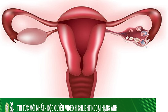 Cô gái trẻ bị suy buồng trứng vì căn bệnh không điều trị kịp thời năm 10 tuổi - Vimarsana News