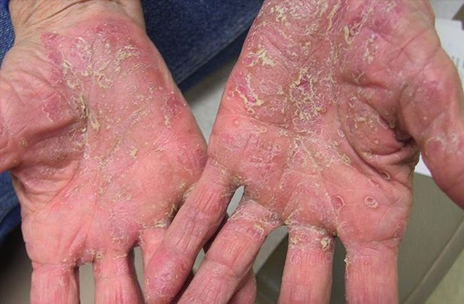 Viêm da ngứa gãi sứt cả da rớm cả máu, đừng bỏ qua kinh nghiệm quý báu này - 2