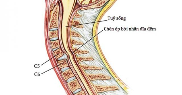 Thoát vị đĩa đệm cổ C5 C6 và giải pháp cải thiện hiệu quả - Vimarsana News