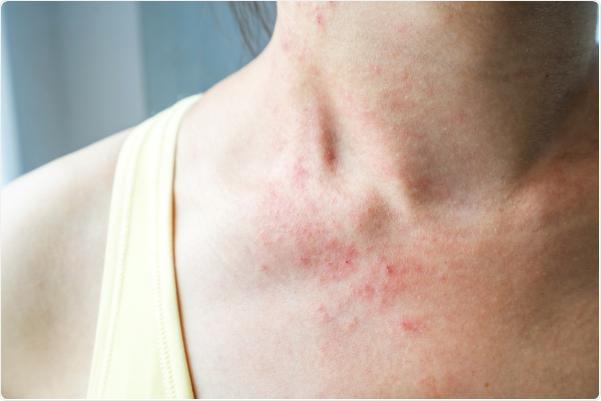 Tự ti vì da nổi mụn, mẩn đỏ trông ‘bẩn bẩn’ hậu COVID-19, nhiều chị em chữa sai cách khiến tình trạng nặng thêm - 1