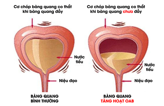 Tiểu đêm 4-5 lần, tiểu ngày chục lần - “Báo động” căn bệnh nguy hiểm ở bàng quang - 3