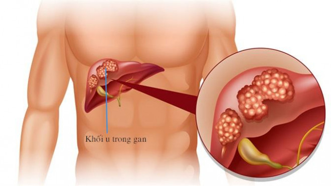 Diễn biến của bệnh ung thư gan và tiên lượng - 1