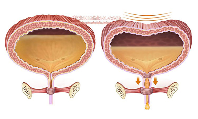 “Khổ sở” vì tiểu đêm quá nhiều – Hóa ra đây chính là nguyên nhân - 2