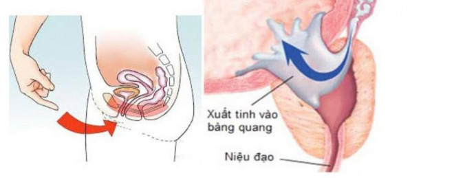 Nguyên nhân không ngờ khiến chàng trai trẻ mắc chứng &#34;mất tích&#34; tinh trùng, rối loạn cương dương - 3