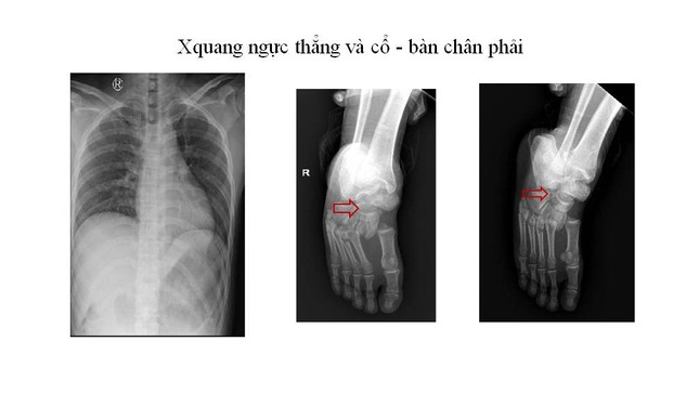 Rơi thang máy, 2 công nhân trọng thương - 2