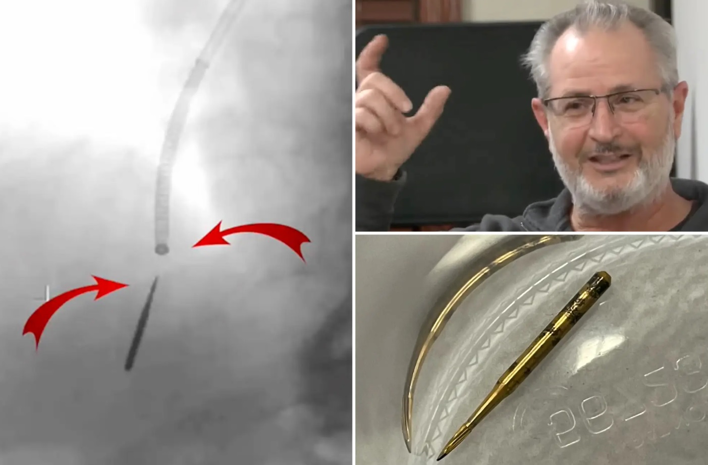 Người đàn ông suýt cắt bỏ 1 phần phổi vì hít phải mũi khoan khi làm răng - 1