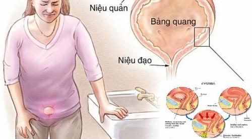 Đi tiểu sau khi quan hệ tình dục có ngăn được nhiễm trùng tiết niệu? - 3