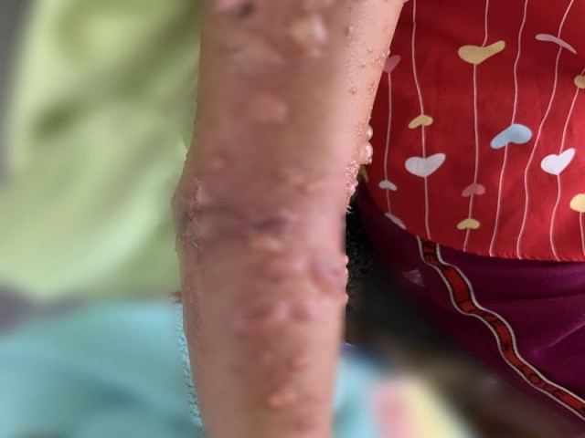 Bé gái nhập viện vì bỏng da nặng do tiếp xúc sứa biển