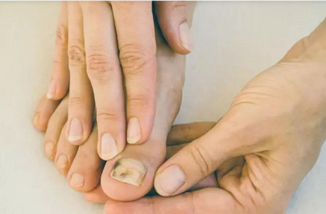 Phát hiện mắc ung thư nhờ điểm lạ ở ngón chân, chuyên gia cho biết người  phụ nữ này 