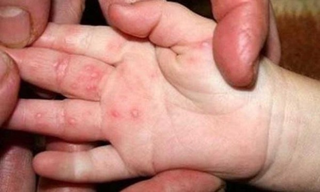 Bệnh tay chân miệng ở Hà Nội tăng nhanh, cha mẹ cần chú ý dấu hiệu nặng - 1