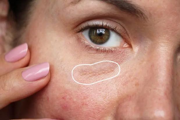 Mụn thịt chữa cách gì? - 2
