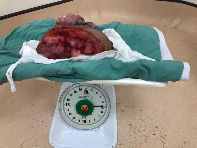 Hơn một năm khối u vú bằng trái chanh phát triển &#39;siêu tốc&#39; nặng gần 5 kg - 2