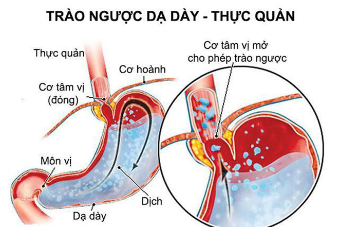 Cách thoát đầy hơi, chướng bụng liên tục – Ai cũng làm được! - 2