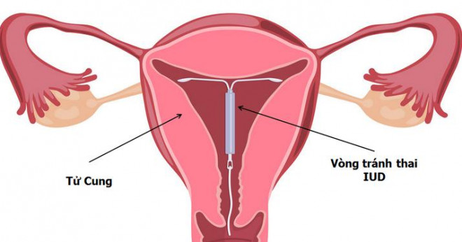 Lý giải 6 băn khoăn thường gặp về &#34;chuyện ấy&#34; khi phụ nữ đặt vòng tránh thai - 2