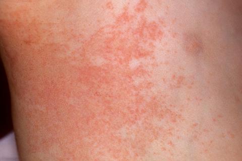 6 vấn đề của làn da khi nắng nóng và mẹo để phục hồi - 1