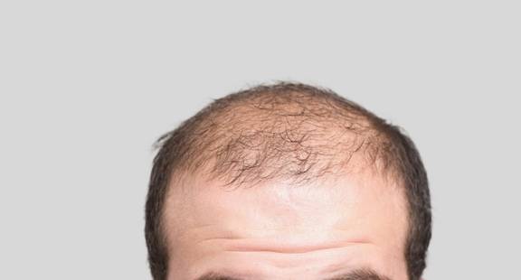 3 dấu hiệu đặc trưng ở cánh mày râu cho thấy nội tiết tố nam đang dần suy giảm - 1