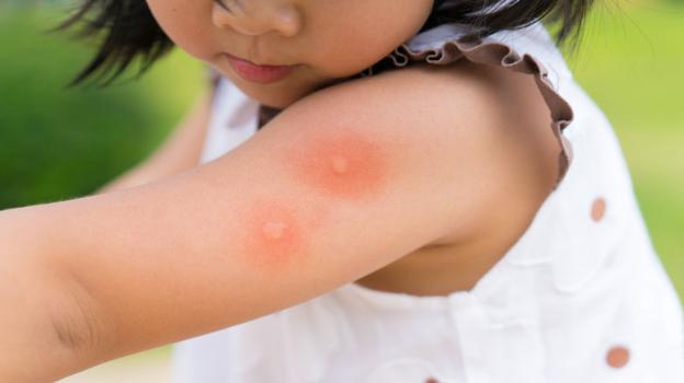 8 biện pháp giảm ngứa, ngăn ngừa nhiễm trùng do muỗi đốt - 1