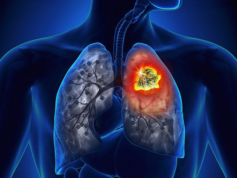 Quan điểm “đã mắc ung thư phổi là nhận bản án tử”: Đúng hay sai? - 1