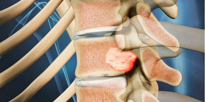 Cơ thể thường xuyên xuất hiện 5 triệu chứng này, rất có thể u tủy đang ghé thăm - 3