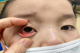 Hậu COVID-19, trẻ bị đau mắt đỏ, cộm mắt: Cha mẹ cần chú ý những dấu hiệu để đi khám