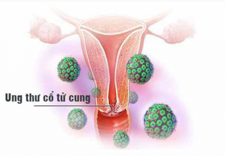 Nhiễm virus HPV có nhất thiết phải tầm soát ung thư cổ tử cung? - 1