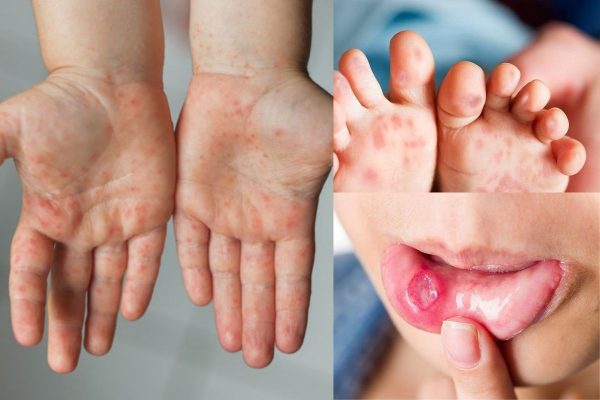 Dịch tay chân miệng bùng phát, xuất hiện chủng virus dễ gây bệnh nặng - 1