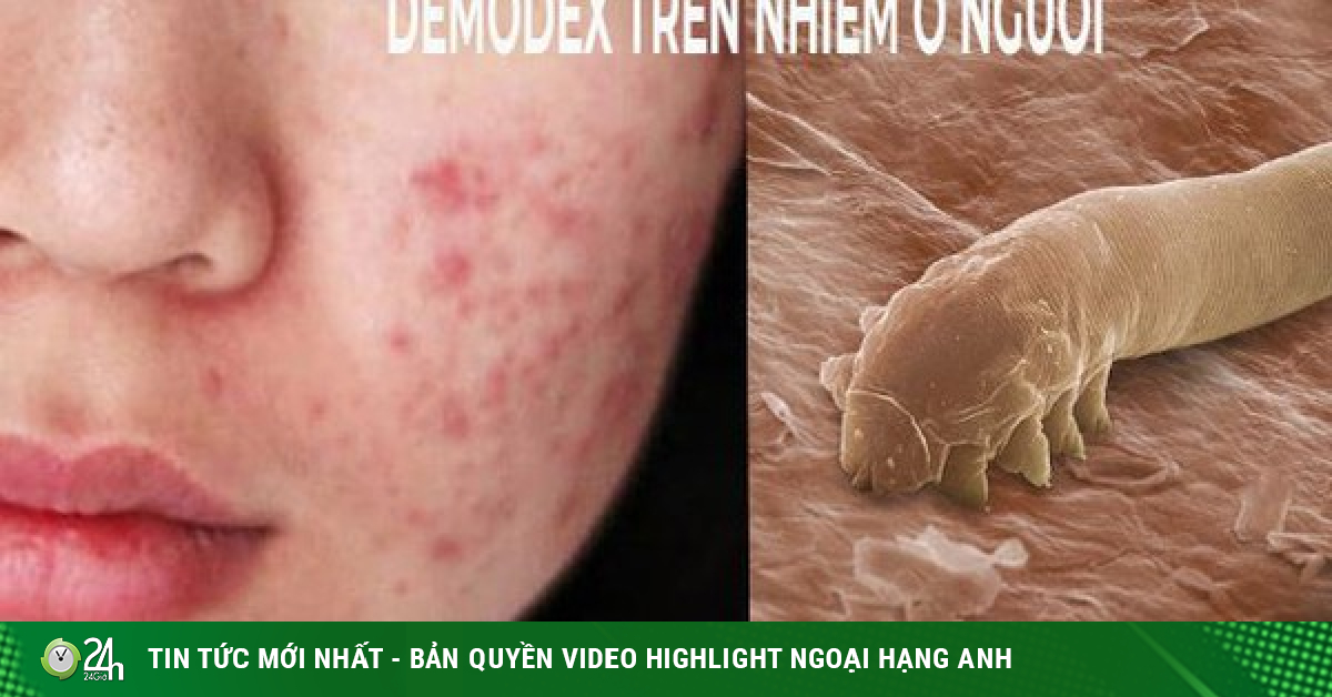 Face with pimples, red papules, itching like ants, you may have a