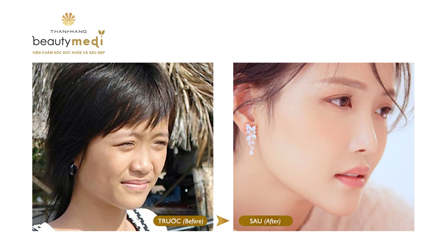 Chương trình “Làm đẹp từ tâm - nâng tầm nhan sắc” – Cơ hội nâng mũi đẹp như sao Hàn chỉ 0 đồng - 3