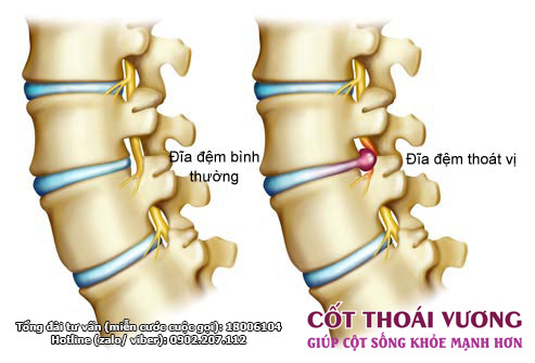Phát hiện mới giúp giảm đau lưng và cải thiện tình trạng thoát vị đĩa đệm - 1