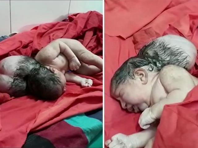 Trẻ sơ sinh 3 đầu như ”người ngoài hành tinh” khiến các bác sĩ choáng váng