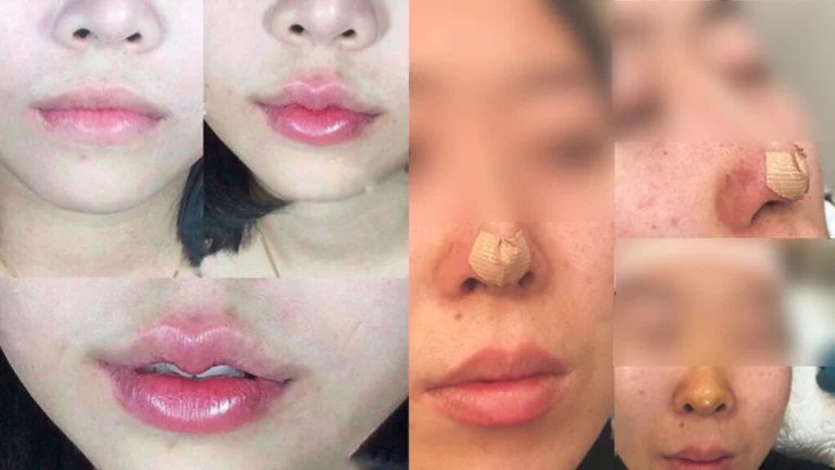 Hàng trăm người Việt ở Úc có thể đã nhiễm HIV tại thẩm mỹ viện