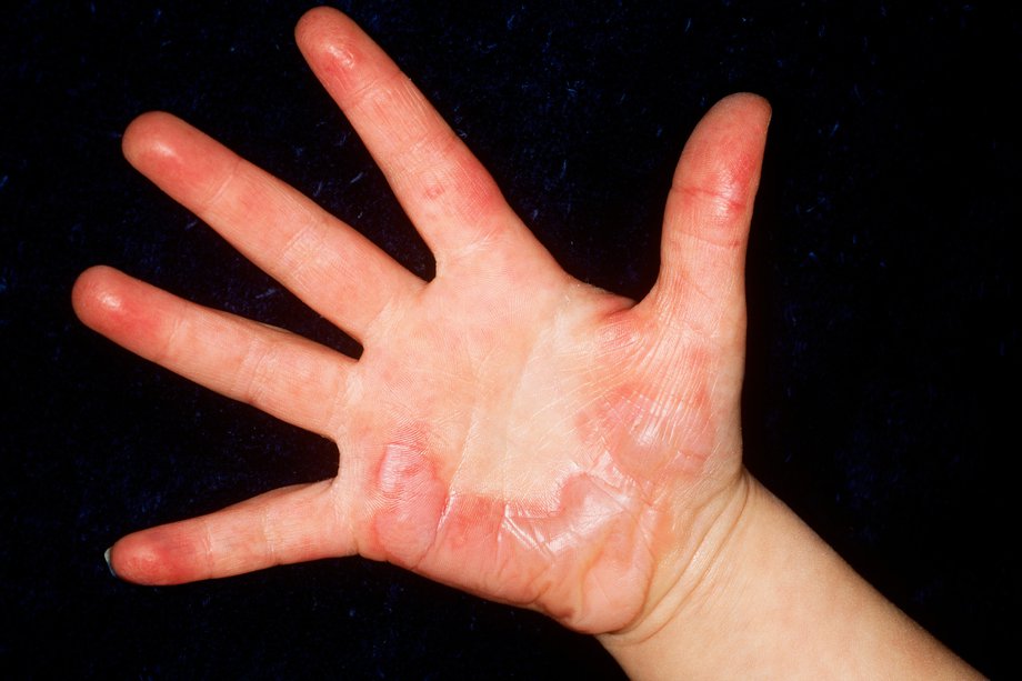 Làm thế nào để tránh nguy cơ trẻ bị bỏng khi ở nhà một mình và cách xử lý đúng? - 1