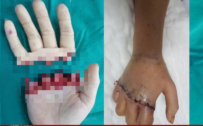 “Cậu bé” và các phần cơ thể đứt rời phải giữ gìn bằng cách này bác sĩ mới nhất định cứu được - 2