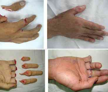 “Cậu bé” và các phần cơ thể đứt rời phải giữ gìn bằng cách này bác sĩ mới nhất định cứu được - 3