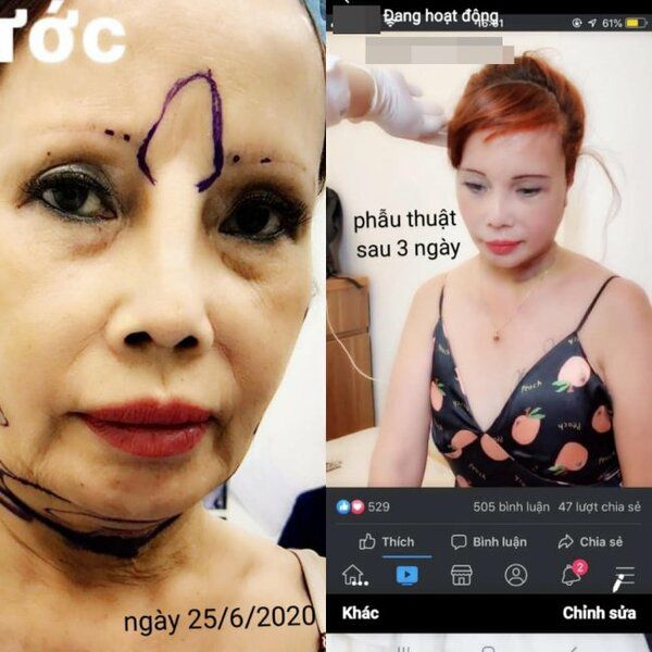 “Cô dâu Cao Bằng 62 tuổi lấy chồng 26” gây sốc khi dự tính tu sửa ngực - 3