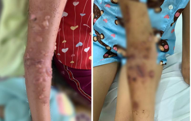 Bé gái nhập viện vì bỏng da nặng do tiếp xúc sứa biển - 1