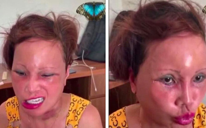 Sau gần 1 tháng dao kéo hoàn thiện, "cô dâu 62 tuổi" Cao Bằng gặp biến chứng méo miệng? - 2