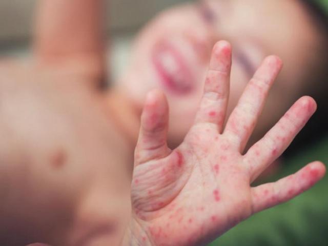 Trẻ mắc tay chân miệng tăng 5-6 lần, dịch lây lan với tốc độ khủng khiếp