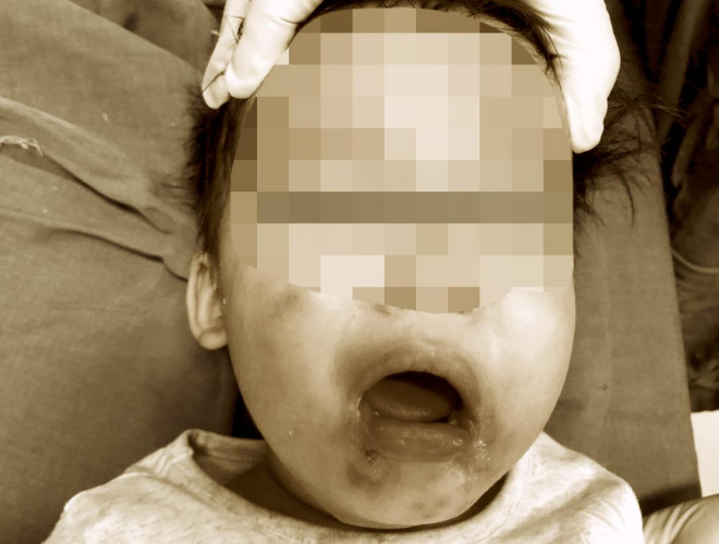 Cắn dây điện trong lúc chơi, bé gái 2 tuổi bị bỏng nặng do điện giật - 2