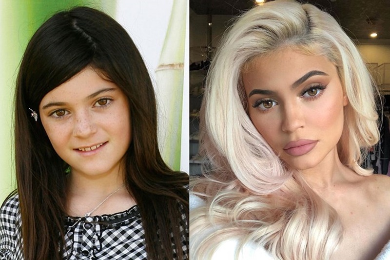 Kylie Jenner bị miệt thị vì phẫu thuật thẩm mỹ - 4