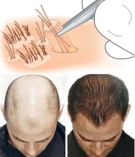 Âu sầu vì hói đầu, phương pháp thẩm mỹ này là dành cho bạn - 4