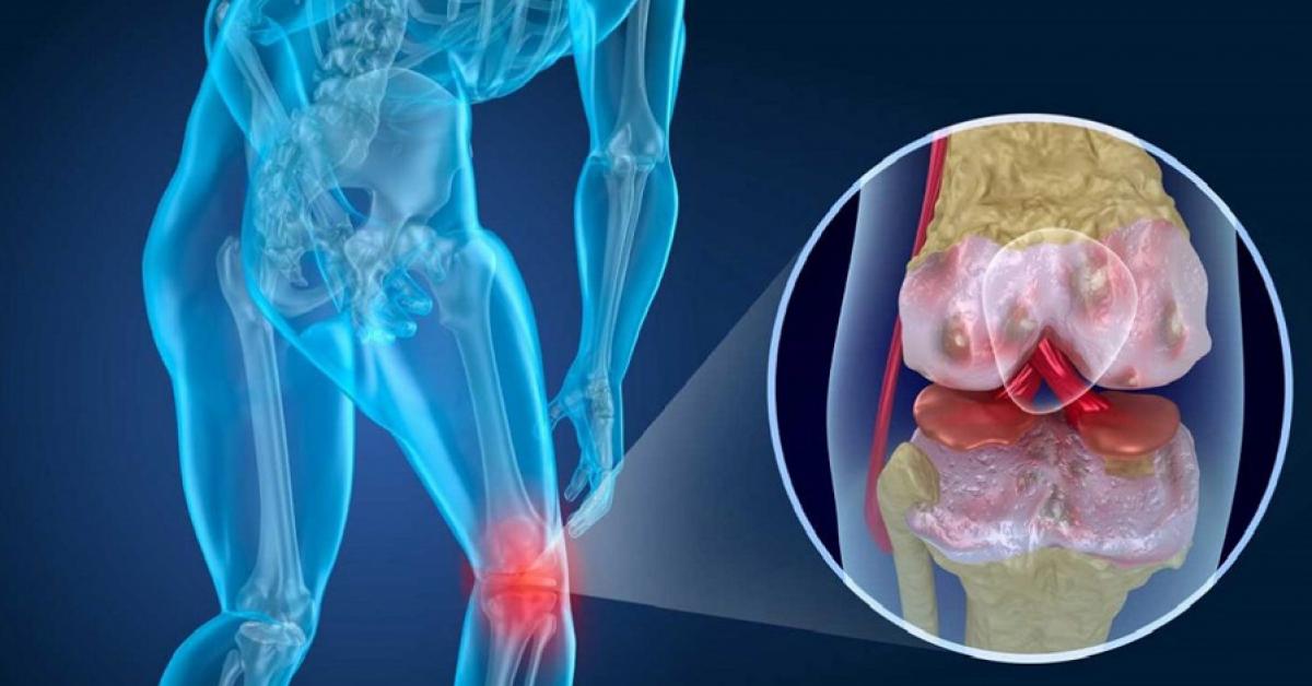 Mẹo cực nhạy: Ai đau nhức xương khớp chỉ dùng thứ này 2 lần/ngày cũng giảm ngay - Vimarsana News