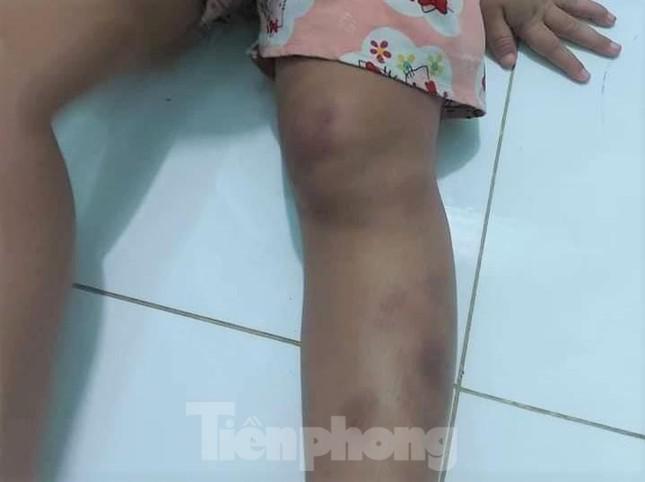 Cha về quê, con bị cô và dượng đánh đập tàn bạo - 4