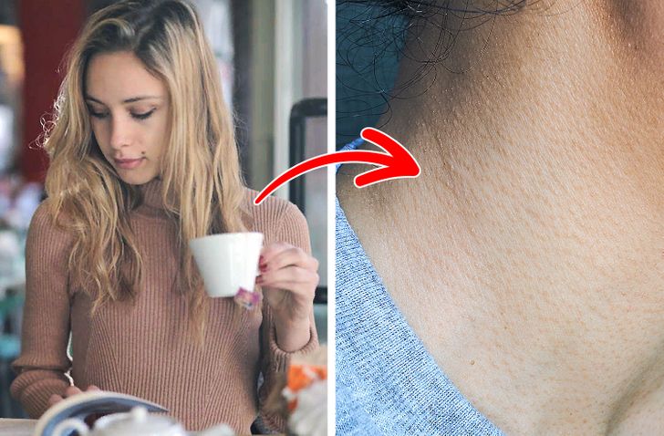 Cách phòng ngừa và trị chứng da gà xấu xí vào mùa hè - 4