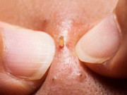 Tư vấn làm đẹp - Nam giới bị mụn: 1 chai màng sinh học 119k là hết, không cần bôi kem như con gái!