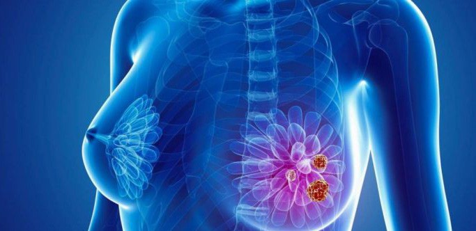 Bác sĩ Bệnh viện K “bật mí” 5 cách để phòng ung thư vú - 1