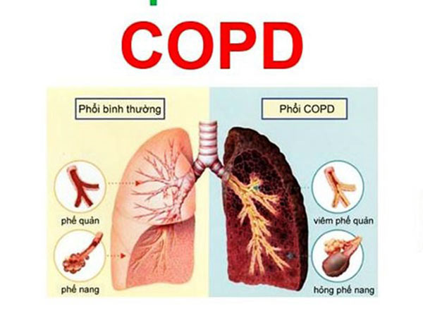 Lactoferrin dưỡng chất vàng cho bệnh nhân COPD, hen suyễn không thể bỏ qua! - 1