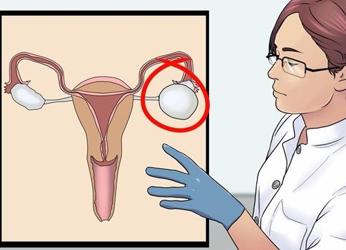 Đa nang buồng trứng và nguy biến khó lường - 3
